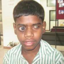 operated for congenital glaucoma