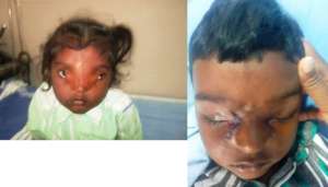 4 yr old operated for rare eye condition