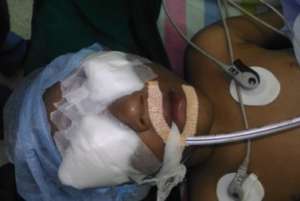3 YR OLD BOY OPERATED FOR CONGENITAL CATARACT