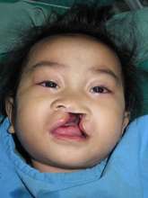 Chelsea Joy Casipit Before Smile Train Surgery