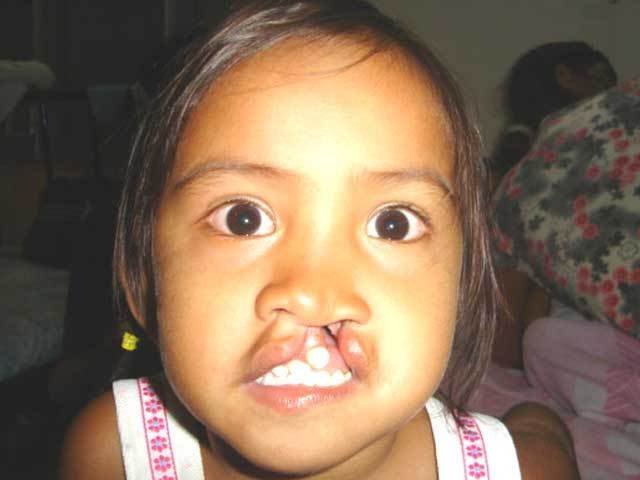 Free Cleft Surgery for 400 Filipino Children