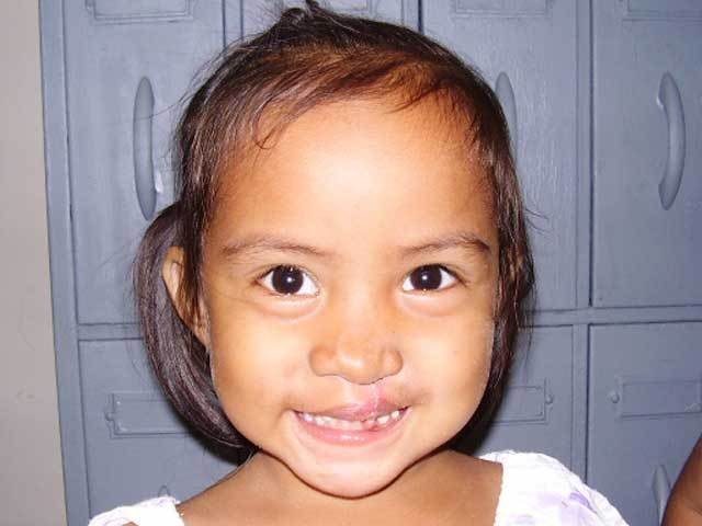 Free Cleft Surgery for 400 Filipino Children