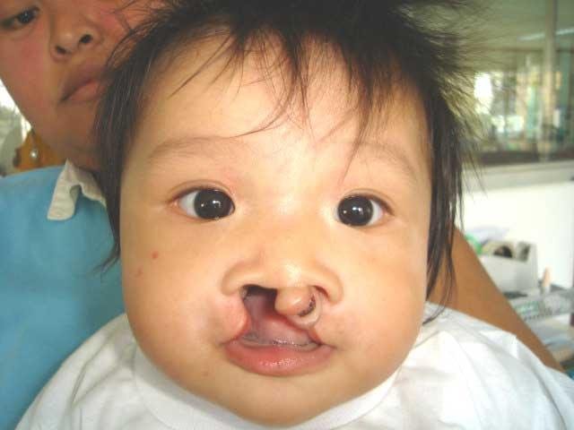 Free Cleft Surgery for 400 Filipino Children