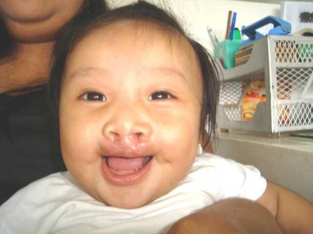 Free Cleft Surgery for 400 Filipino Children