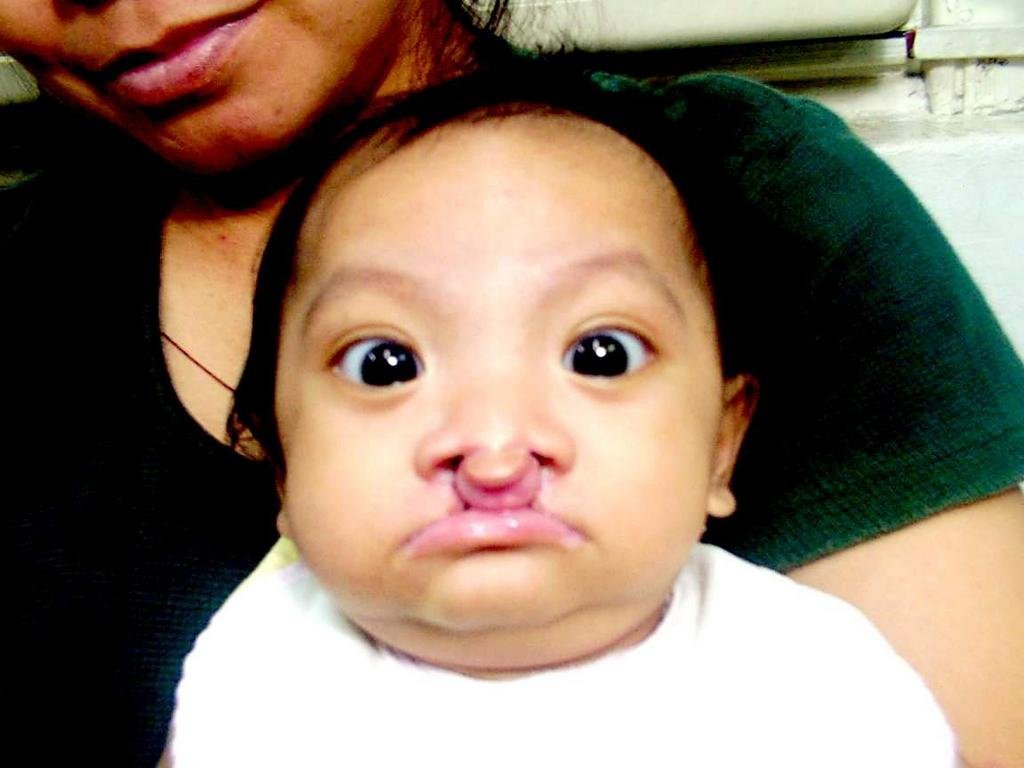 Free Cleft Surgery for 400 Filipino Children