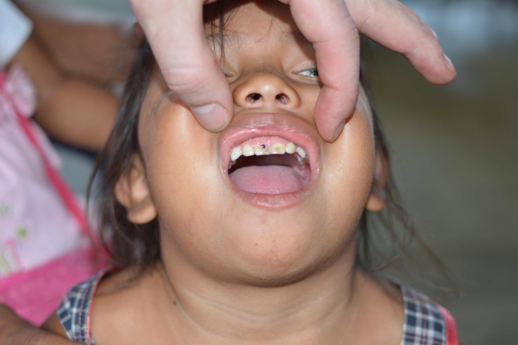Diagnosing and treating anemia in rural Guatemala