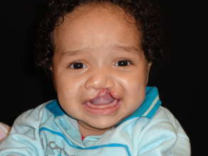 5 month old boy before surgery