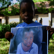 Gabriel, following his free cleft lip surgery.