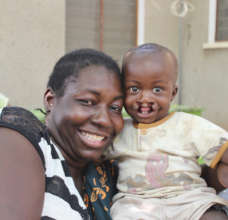 Issa before surgery to repair his cleft lip/palate