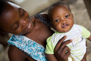 Repair the smile of a child with cleft lip/palate