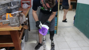 Vera's leg being fabricated
