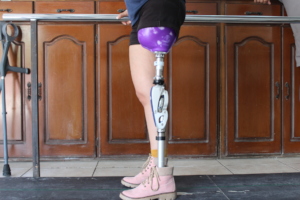 Vera's prosthesis