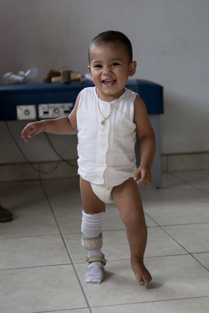 High-tech prosthetics for 75 Guatemalan amputees