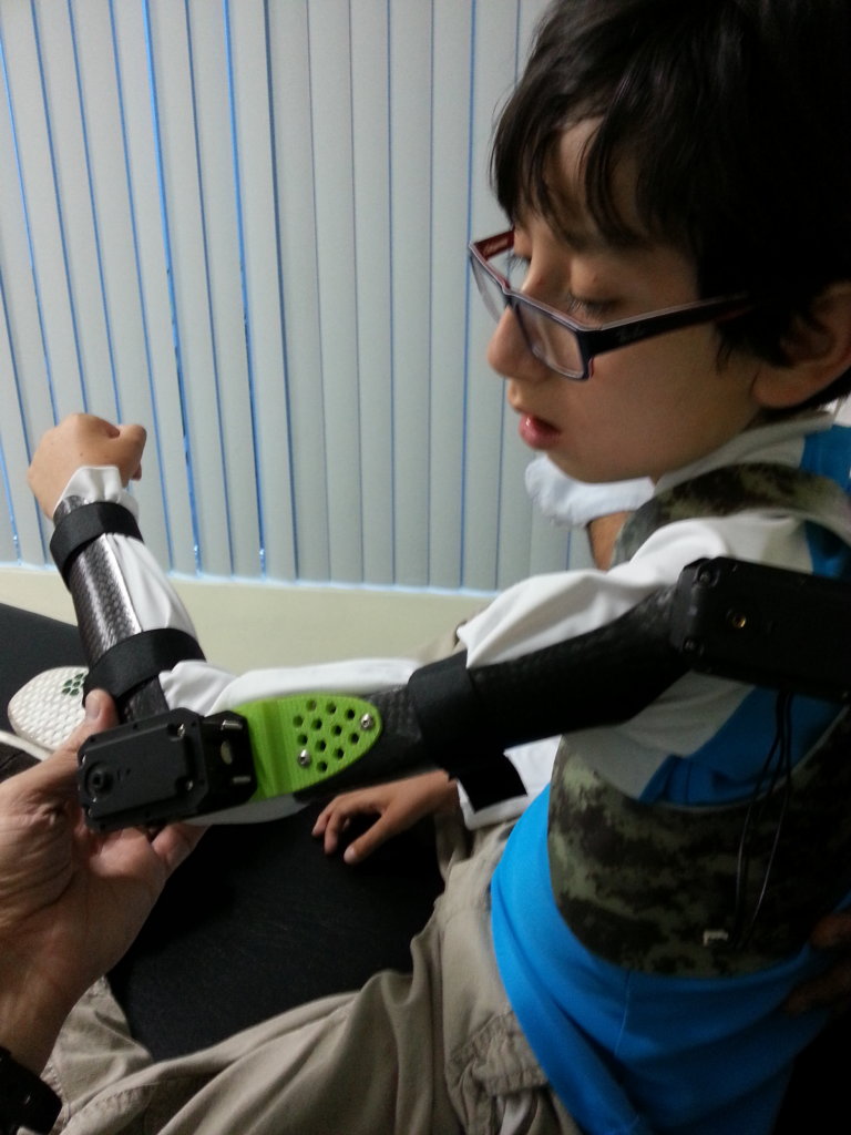 High-tech prosthetics for 75 Guatemalan amputees