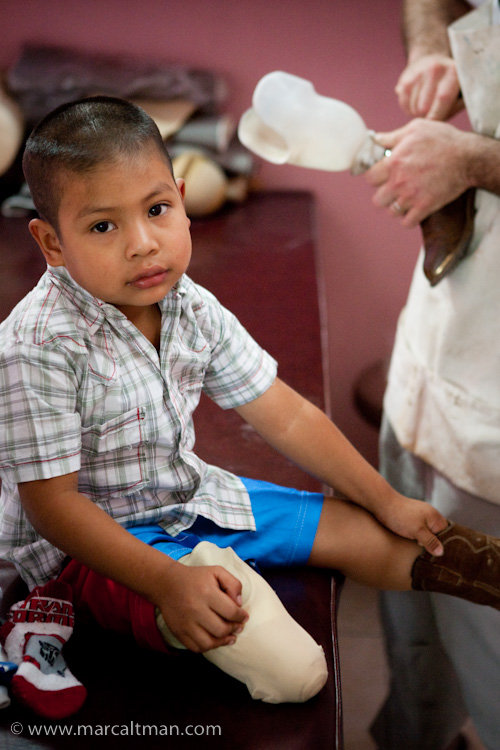 High-tech prosthetics for 75 Guatemalan amputees