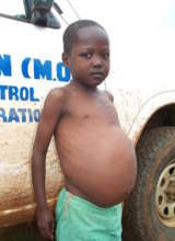 Young boy with heavy infection of schistosomiasis