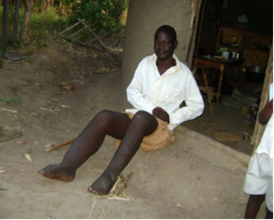 Simiyu’s legs were painfully swollen