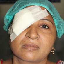 Teemar Bibi Post Surgery