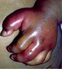 Treat Chronic Leg Ulcers in 50 Nigerians