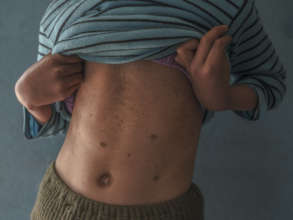 Skin rushes are a common result of pollution