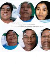 Six donated lens recipients after cataracts