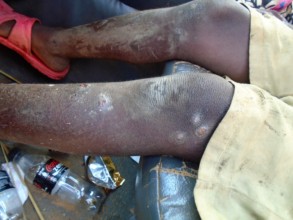 sores on David's legs