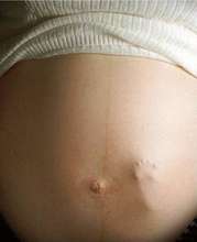 Methamphetamine + Pregnancy = Preemies