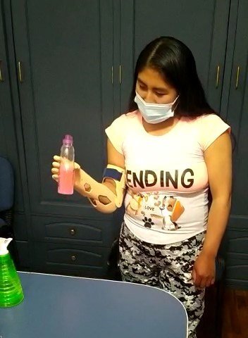 After. Lifting a bottle with her prosthetic hand.