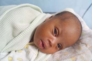 Baby B with Down's Syndrome
