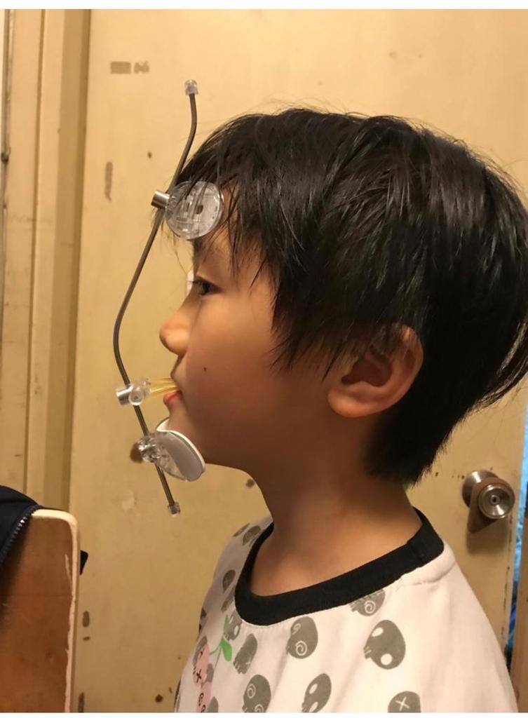 A Child Wearing Reverse Headgear