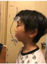 A Child Wearing Reverse Headgear