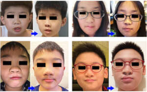 Before & after lip nose revisions