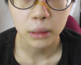 Provision of Nasal Splints (2)