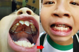 Reverse Headgear (2)