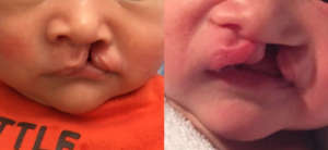 Before and after non-surgical correction