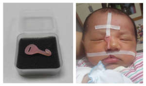 Baby wearing nasal molding and lip correction tape