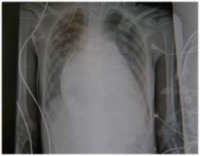 Typical heart failure X-Ray