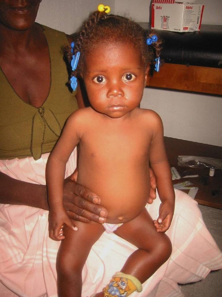 Childhood Malnutrition in post-earthquake Haiti