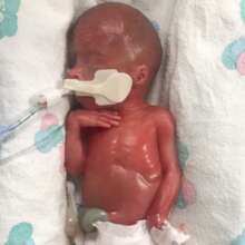 24 week preemie Sammy was born at 23 weeks!
