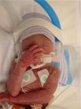Early Intervention for Preemies & Infants...