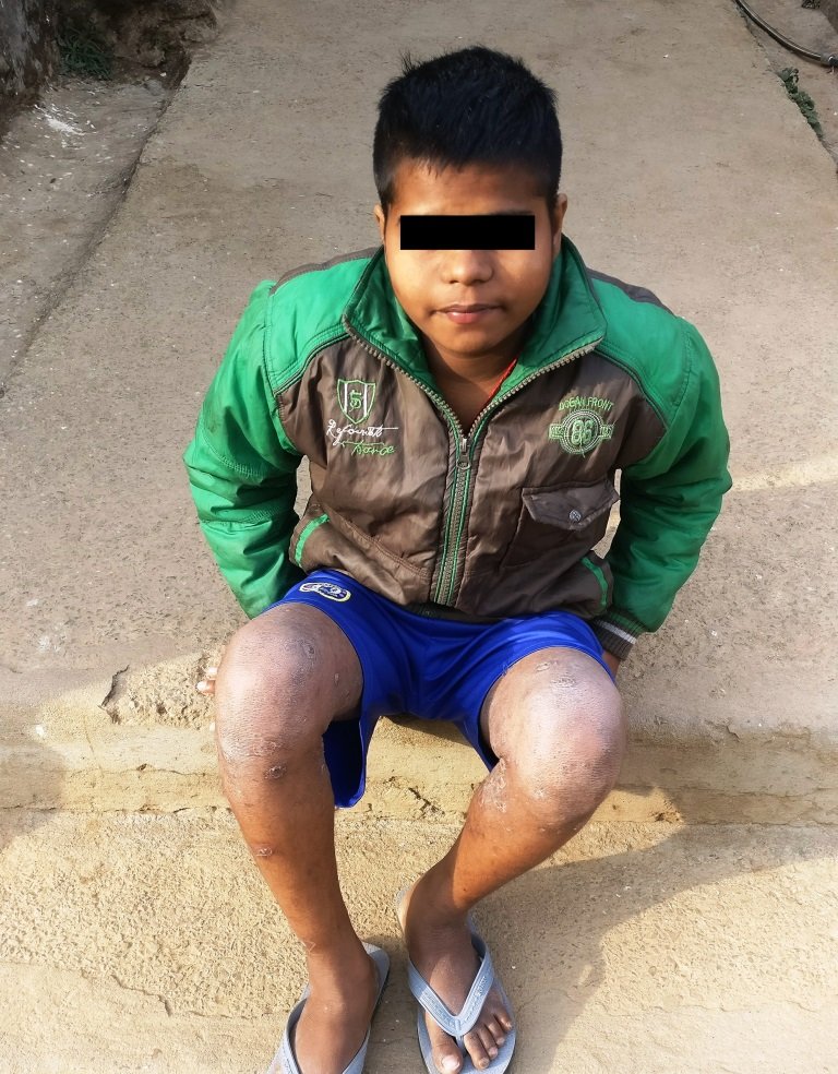 A rescued boy with legs covered in scabies
