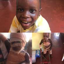 5 year old boy with severe fire burns