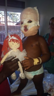 another toddler treated for burns caused by oil