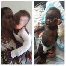 Toddler with severe burns before and after