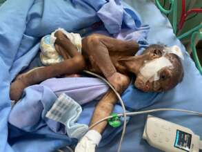 Malnourished baby