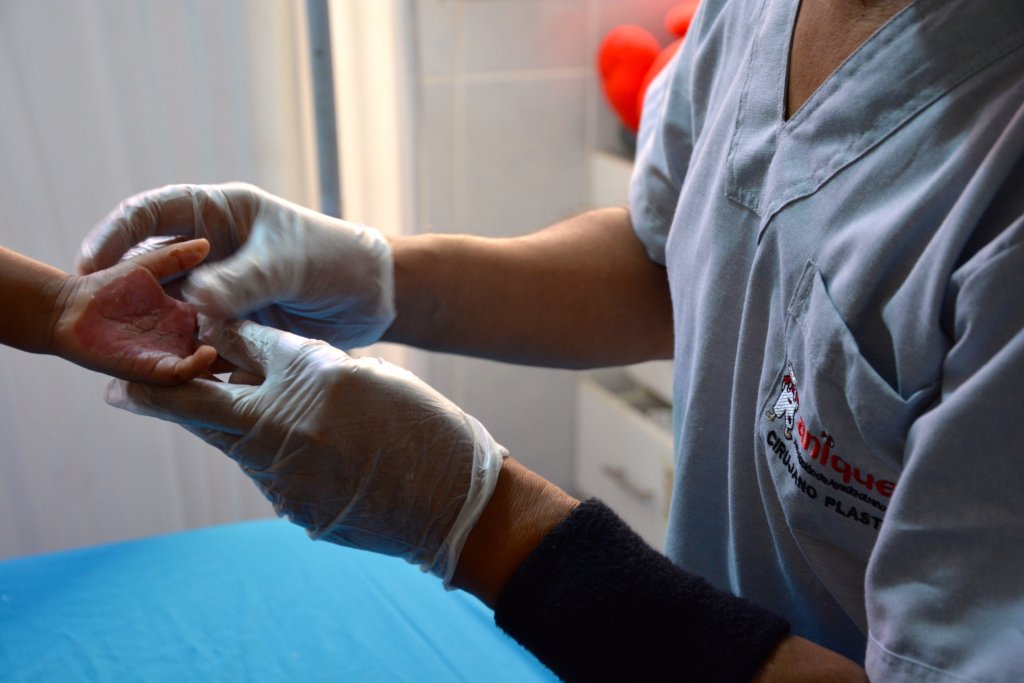 One Year Physiotherapy for 30 Burned Peruvian Kids