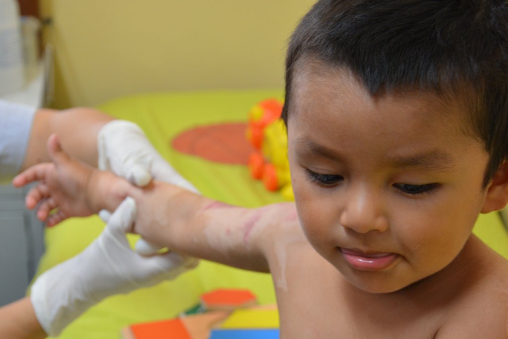 One Year Physiotherapy for 30 Burned Peruvian Kids