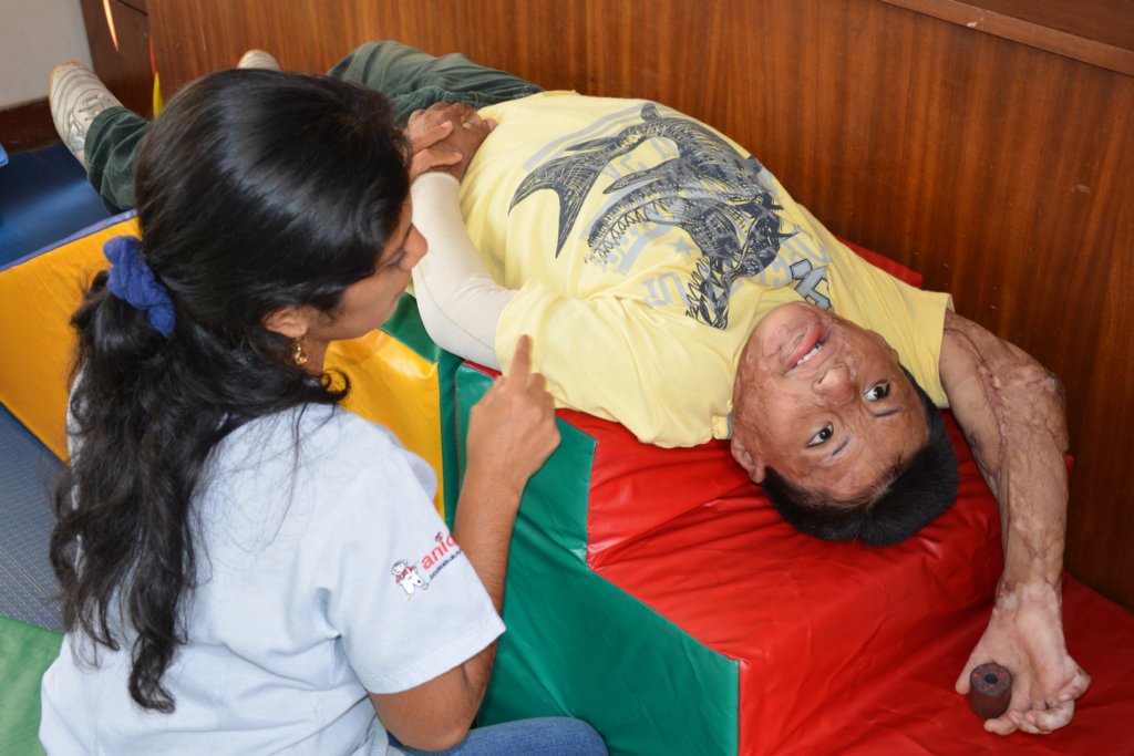 One Year Physiotherapy for 30 Burned Peruvian Kids