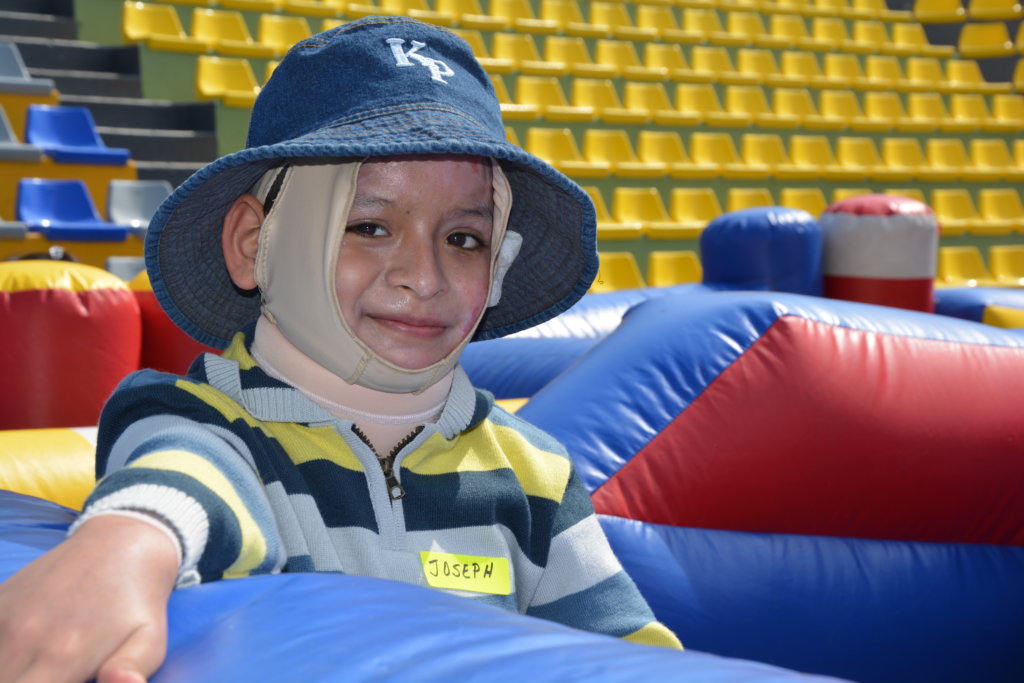 One Year Physiotherapy for 30 Burned Peruvian Kids