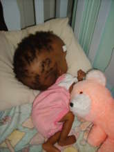 Baby with hydrocephalus